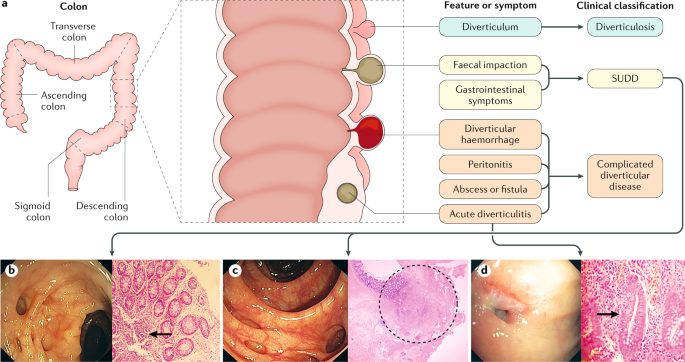 Diverticulitis &#8211; Complementary approaches