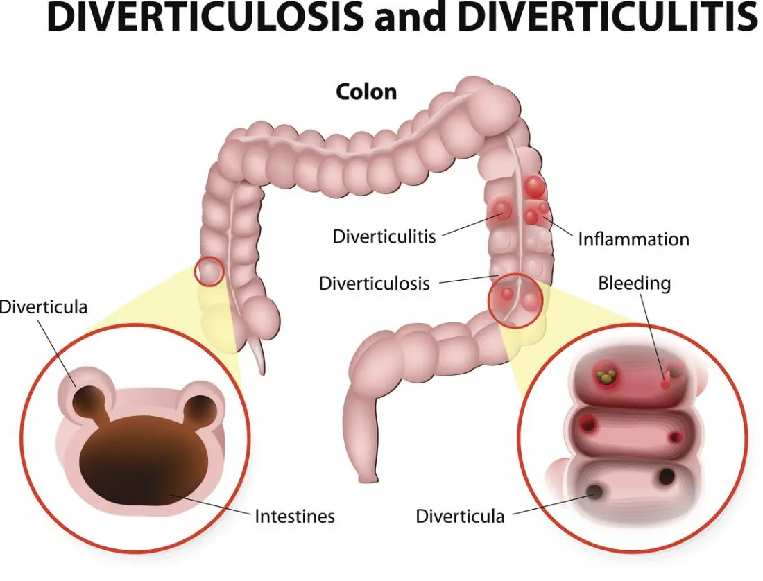 Diverticulitis, diverticulosis, what is it?