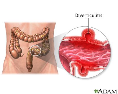 Diverticulitis &#8211; Our doctor&#8217;s opinion