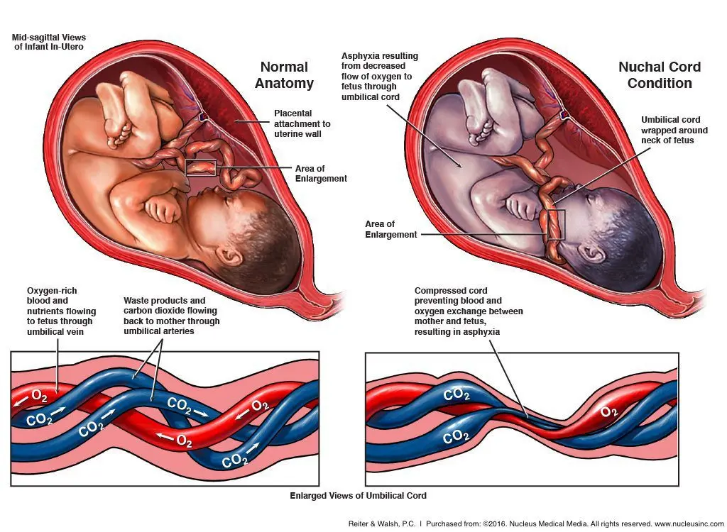 Double entanglement of the umbilical cord of the neck: consequences