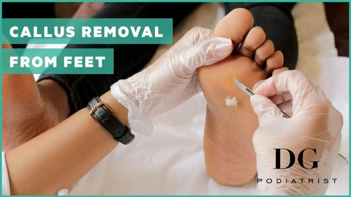 Dry calluses: how to remove? Video