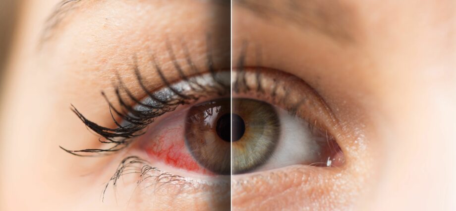Suhe oči: komplementarni pristupi