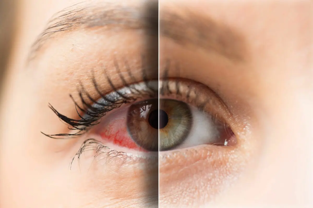 Dry eyes: complementary approaches