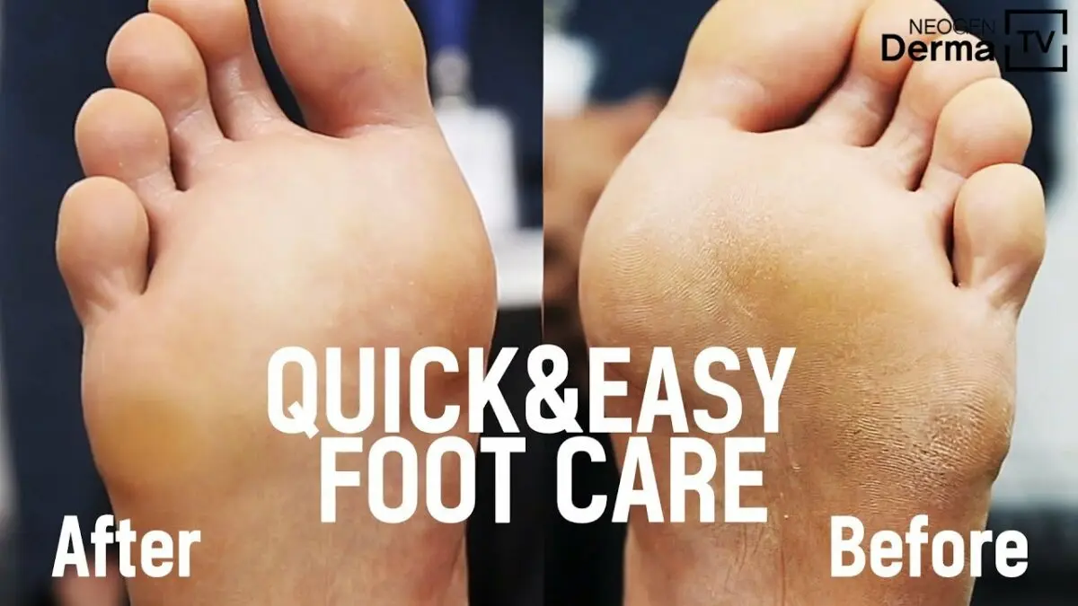 Dry feet: causes and care. Video