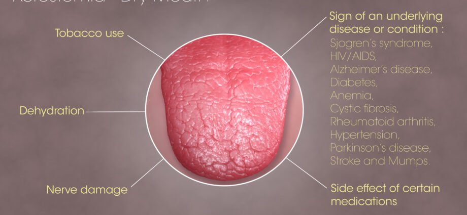 Dry mouth syndrome: symptoms of xerostomia