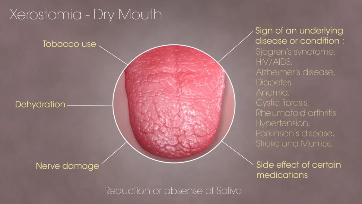 Dry mouth syndrome: symptoms of xerostomia