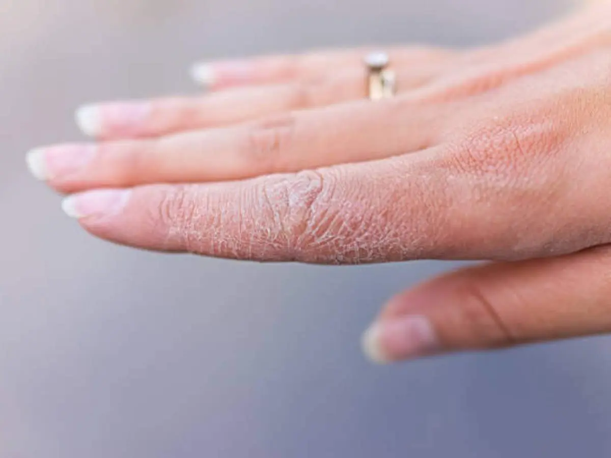 Dry skin on fingers: what to do? Video