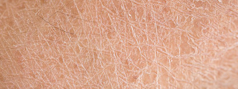 रूखी त्वचा: हमारी त्वचा किससे बनी है, कौन प्रभावित है और इसका इलाज कैसे करें?