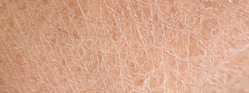 Dry skin: symptoms