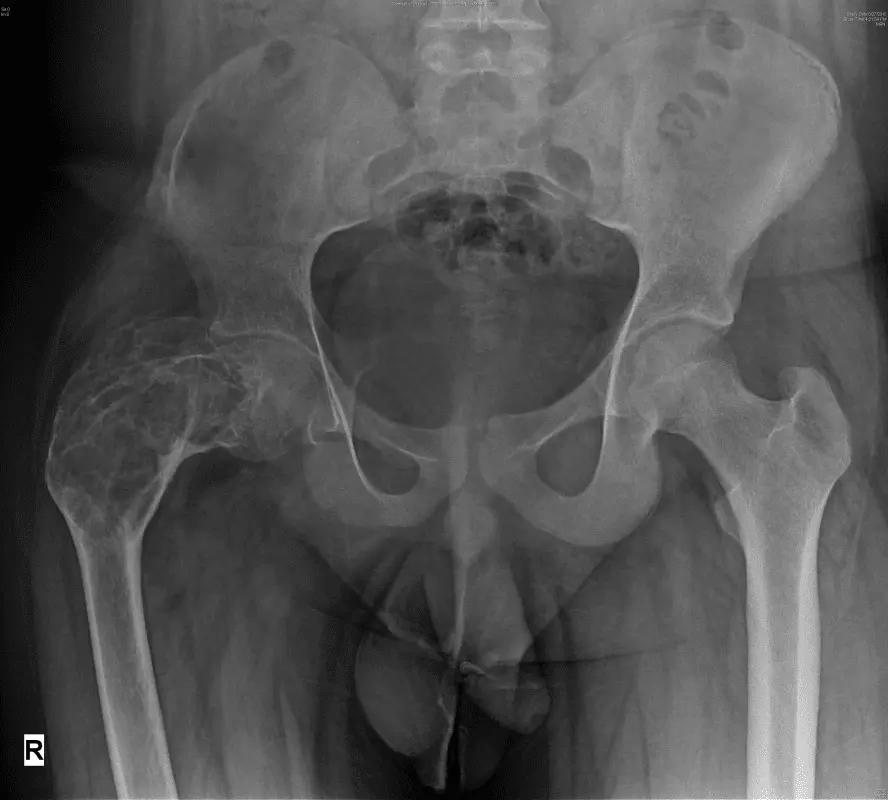 Dysplasia (hip, fibrous, ectodermal): what is it?