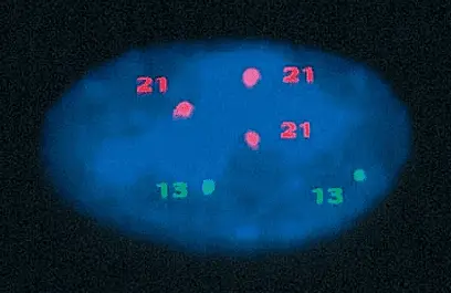 Early detection of trisomy 21: towards an alternative to current tests