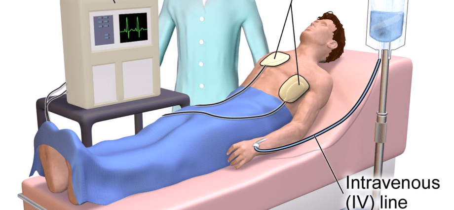 Elektromos kardioverzió: hogyan megy?