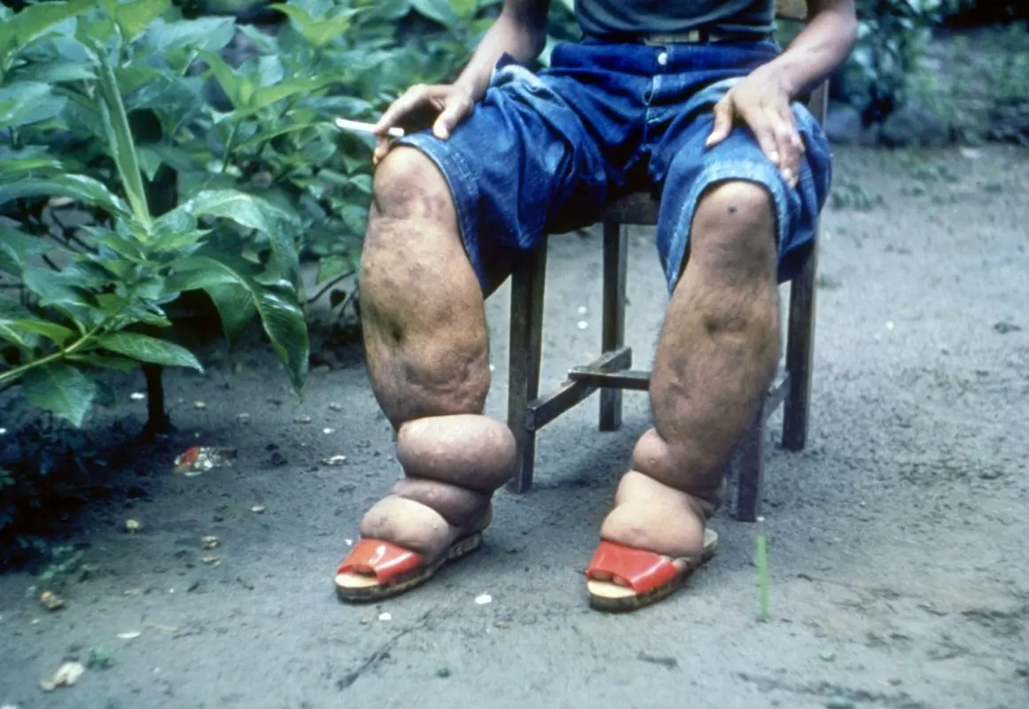 Elephantiasis