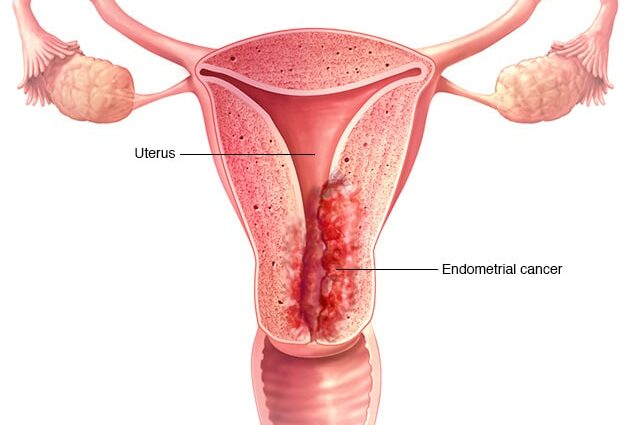 자궁내막암(자궁)