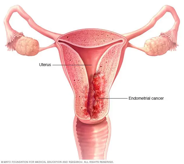 Endometrial cancer (body of the womb)