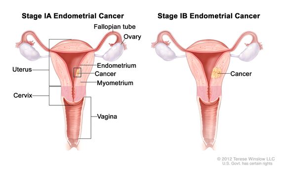 Endomeetriumi vähk (emaka keha) - huvipakkuvad saidid ja tugirühmad
