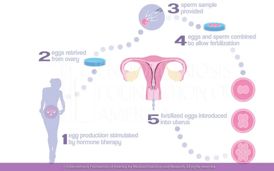 Endometriosis and other causes of infertility photos