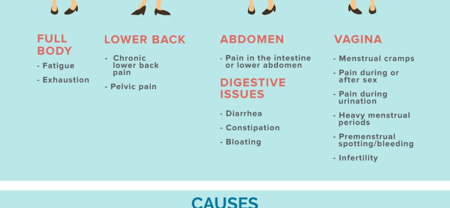 Endometriosis is the main cause of infertility in women. Endometriosis signs, symptoms and treatments