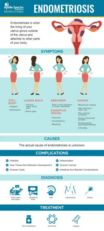 Endometriosis is the main cause of infertility in women. Endometriosis signs, symptoms and treatments