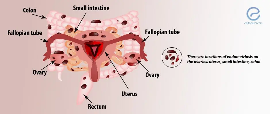 Endometriosis &#8211; Sites of interest