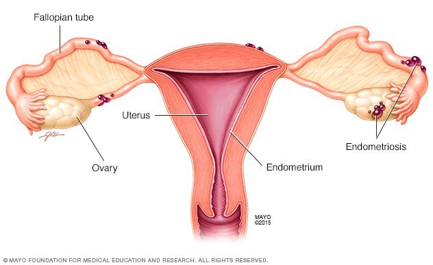 endometrioze