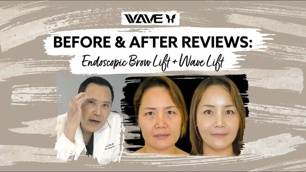 Endoscopic facelift: reviews. Video