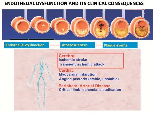 Endothelial: what is endothelial dysfunction?