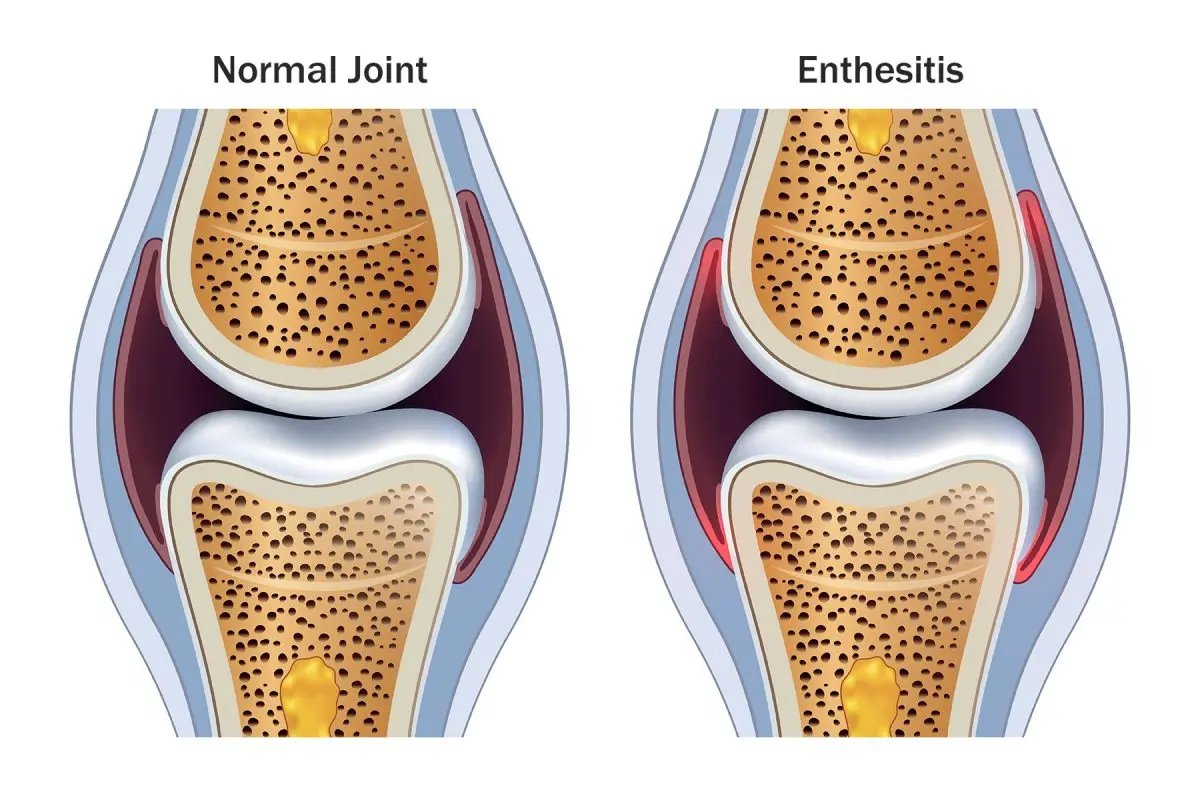 Enthesopathy