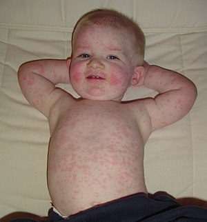 Epidemic megalerythema, what is it?