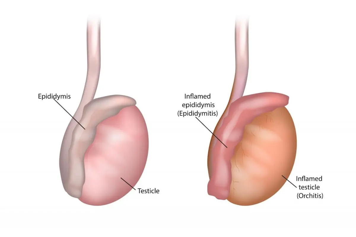 Epididymitis: the inflammation of epididymitis