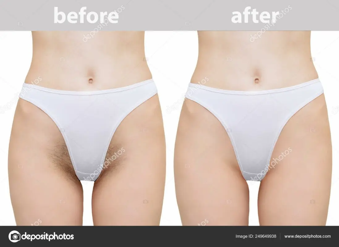 Epilation of legs and bikini area: the best method