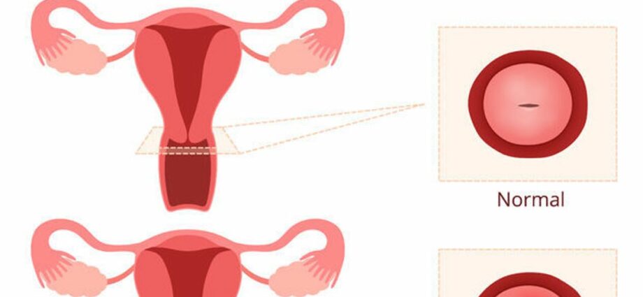 Erosion of the cervix &#8211; treatment