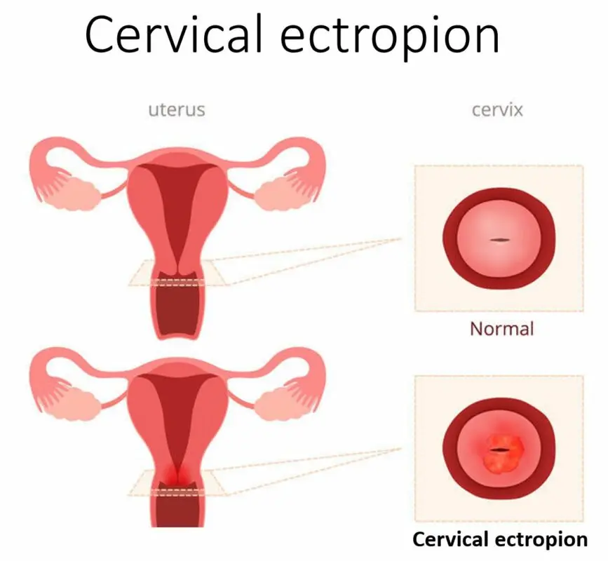 Erosion of the cervix &#8211; treatment