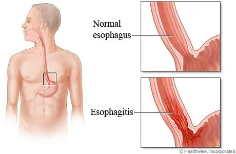 Esophagitis, what is it?