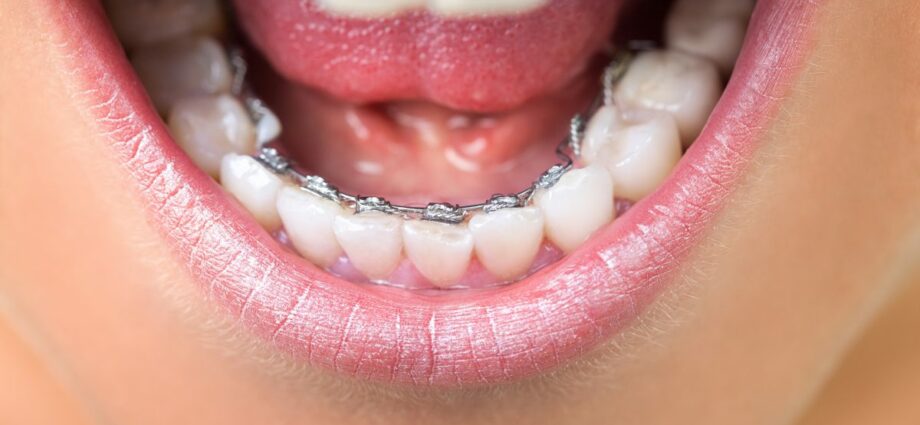 Everything you need to know about braces: the dentist says