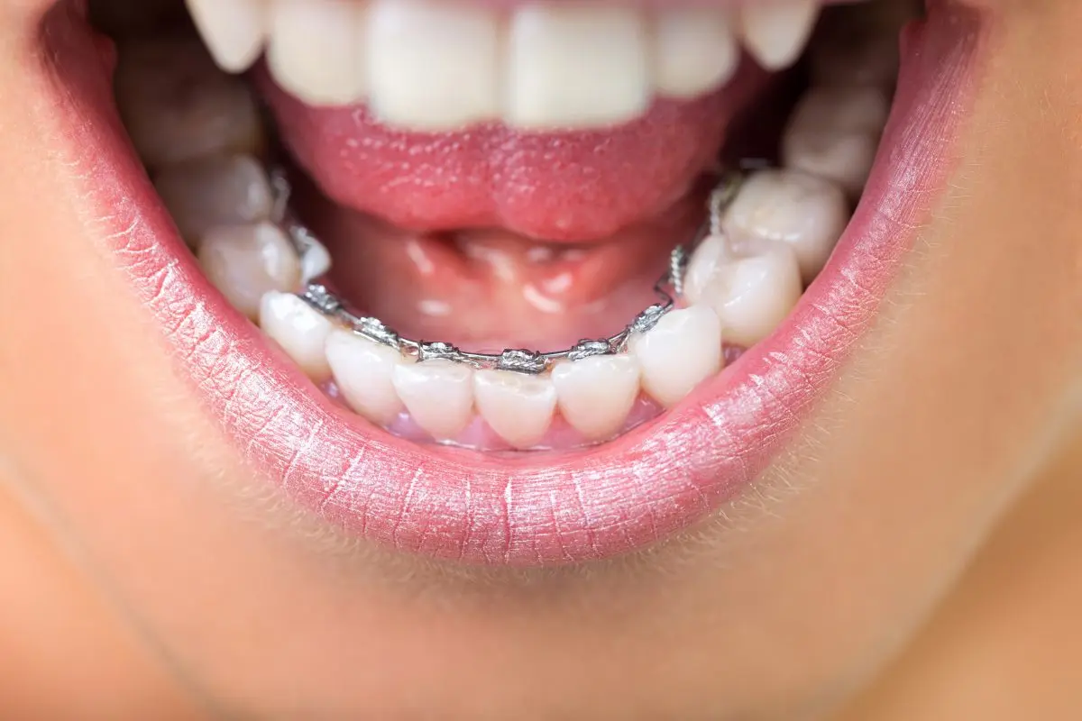 Everything you need to know about braces: the dentist says