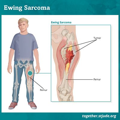 Ewing sarcoma