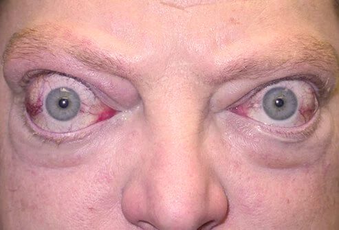 Exophthalmos (bulende øyne)