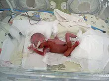 Extremely low weight premature birth