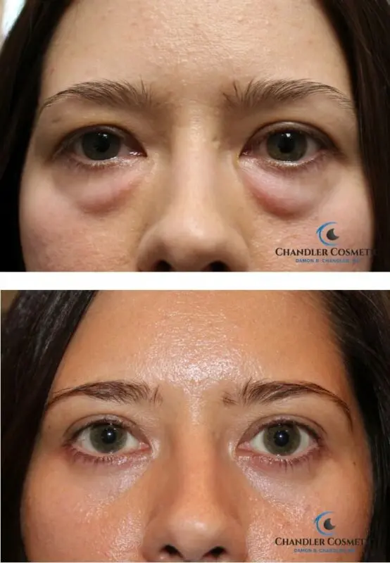 Eyelid blepharoplasty, or how to remove bags under the eyes