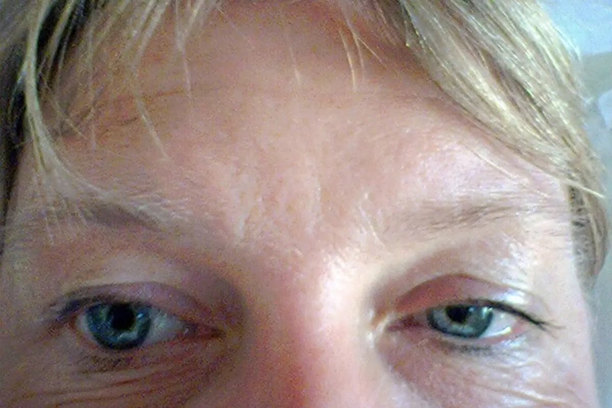 Eyelids droop, what to do