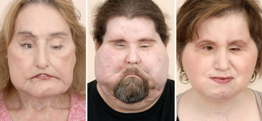 Face transplant surgery is getting more and more popular