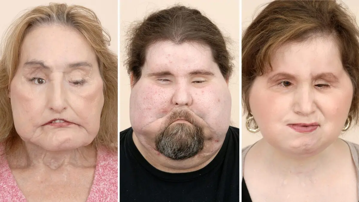 Face transplant surgery is getting more and more popular