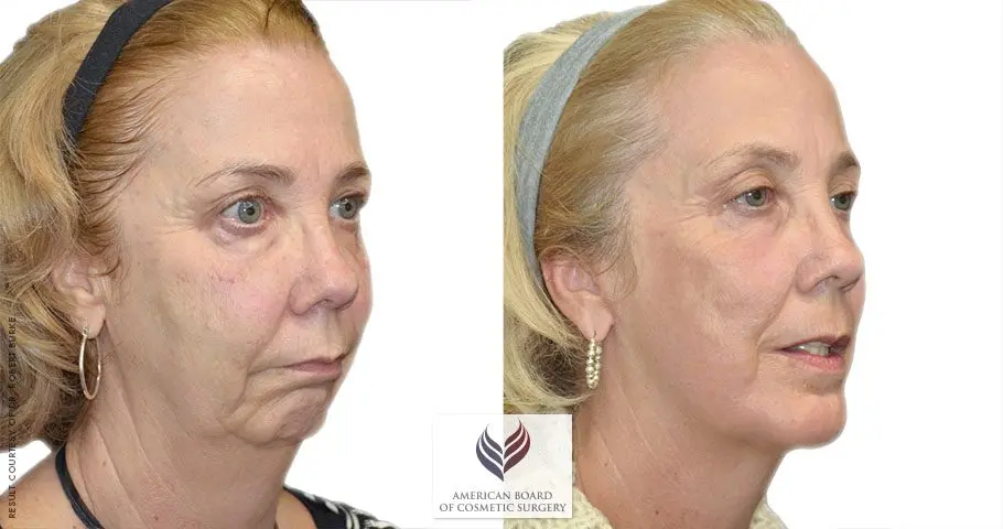 Facelift &#8211; a new direction in cosmetic surgery