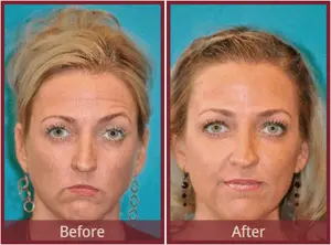 Facelift without surgery: why you need to go to the dentist for a facelift