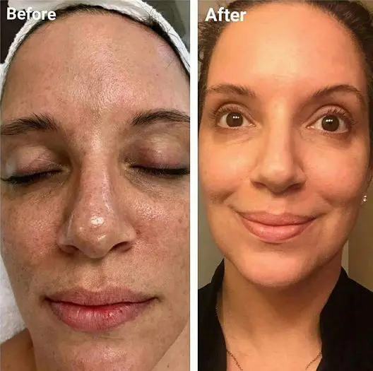 Facial peeling reviews