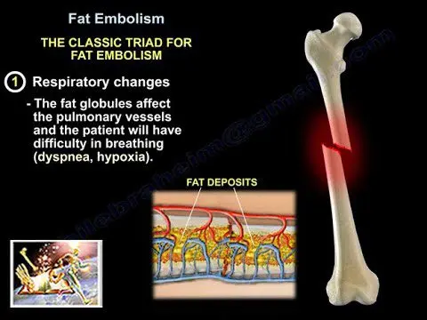 Fat embolism