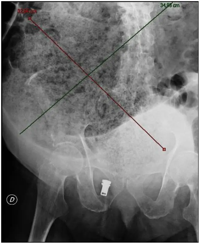 Fecaloma: definition, symptoms and treatments