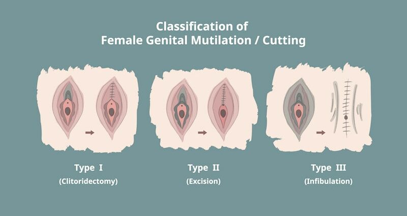 Circuncisión feminina que é e por que o fai unha opinión de expertos