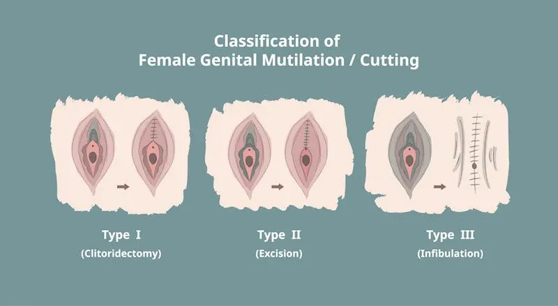 Female circumcision what is it and why is it done by an expert opinion